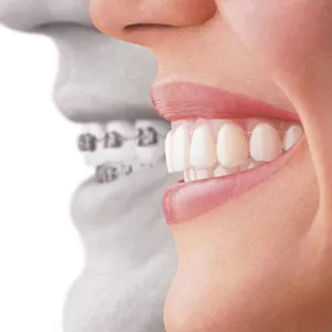  Стоматологічна клініка в Сумах Dentistree proc_invisalign_side.jpg