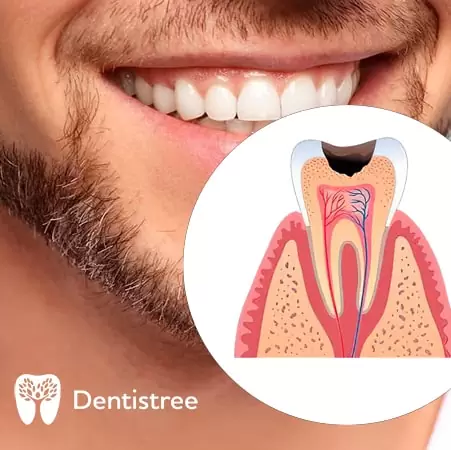  Стоматология в Сумах Dentistree caries-1-min.jpg