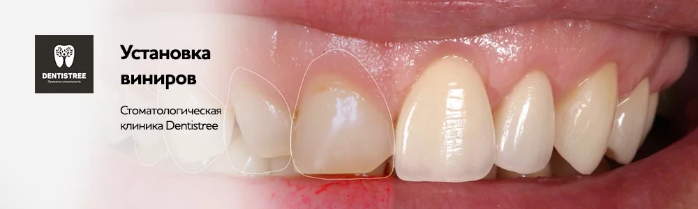  Реставрація зубів у Сумах restavration2
