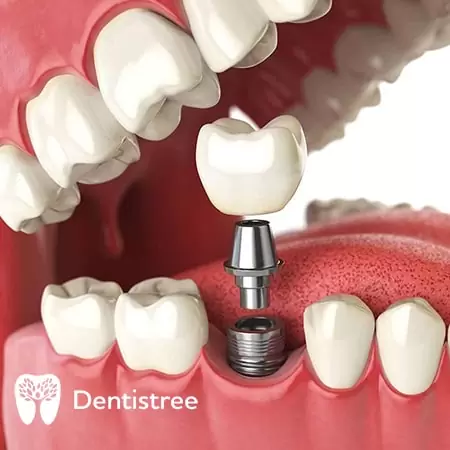  Стоматологічна клініка в Сумах Dentistree protezirovanie_na_implantax-min.jpg