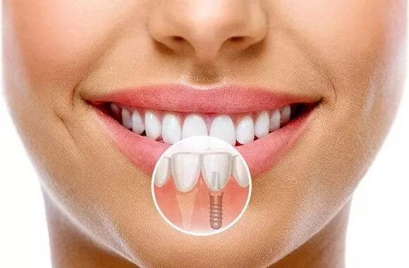  Стоматологічна клініка в Сумах Dentistree ustanovka_implanta_zuba-580x381.jpg