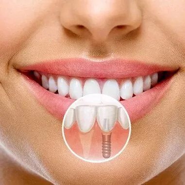 Імплантація зубів (імпланти)